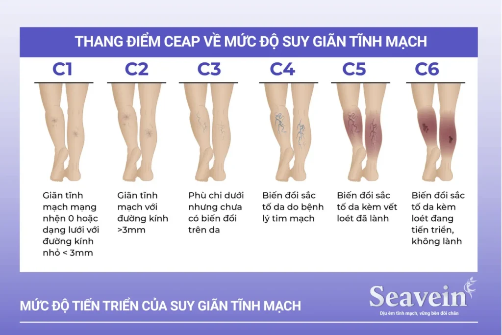 Bệnh suy giãn tĩnh mạch có nguy hiểm không? Để lâu có sao không?