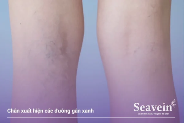 Nổi Gân Xanh Ở Chân là gì? Đây là tất cả những điều bạn cần biết