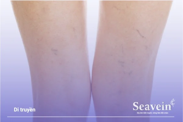 Nguyên nhân gây suy giãn tĩnh mạch