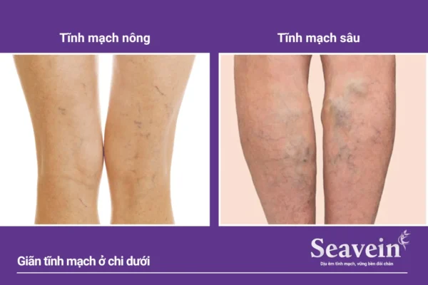 Nổi Gân Xanh Ở Chân là gì? Đây là tất cả những điều bạn cần biết