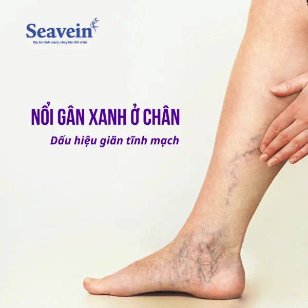 Nổi Gân Xanh Ở Chân là gì? Đây là tất cả những điều bạn cần biết