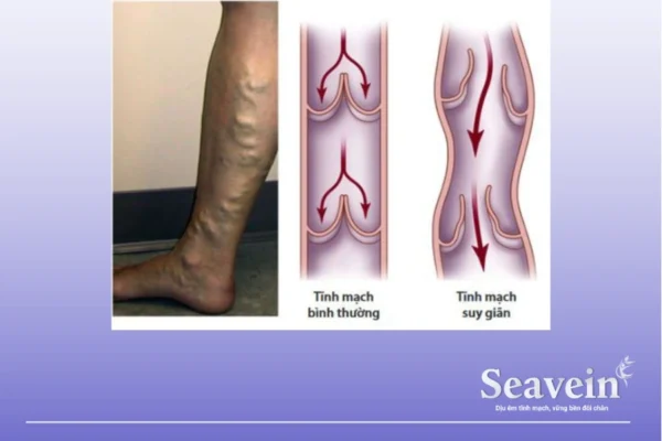 Vì Sao Dân Văn Phòng Dễ Bị Suy Giãn Tĩnh Mạch?